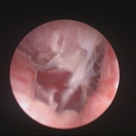Otoscopie - Polype dans l’oreille moyenne.